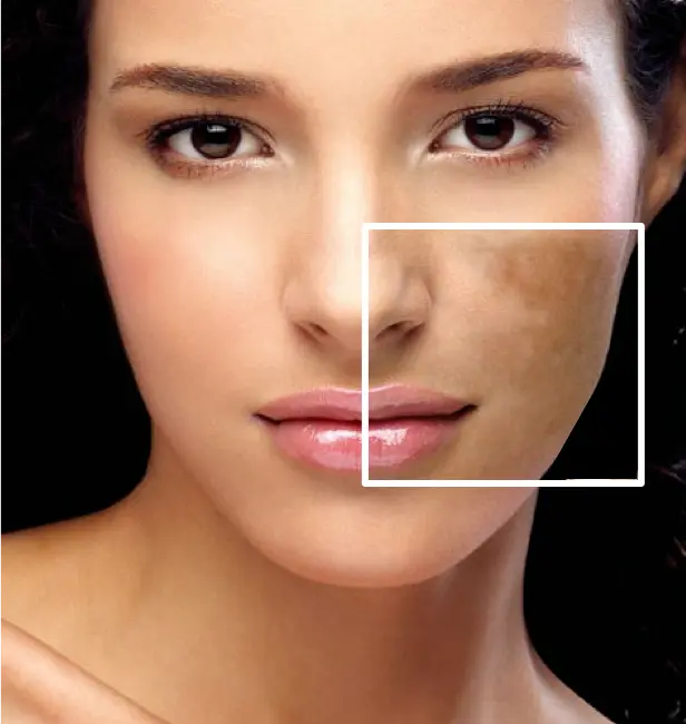 Melasma Face 