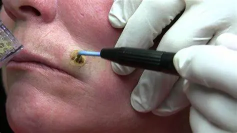 Mole Removal 