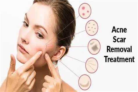 Acne & Scars Face & Neck