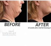 Fat Freezing Double Chin