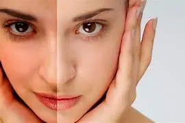 Laser Whitening Brazilian