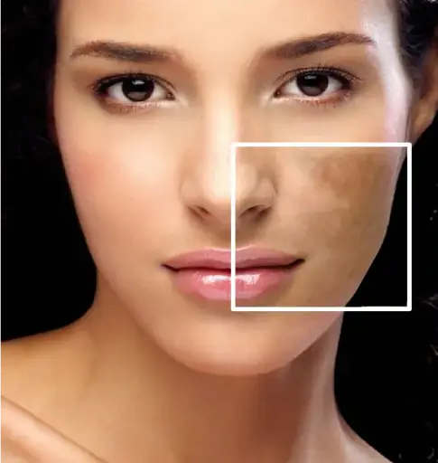 Skin Pigmentation Face 
