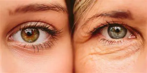 Eye Wrinkles/Eye Bags