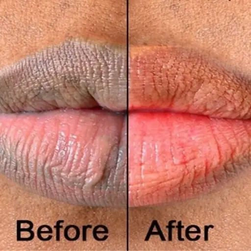 Lip Depigmentation