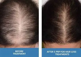 PRP Hair 
