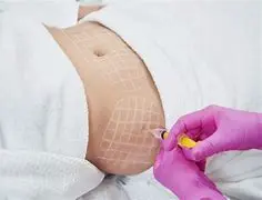 Lypolysis Belly 
